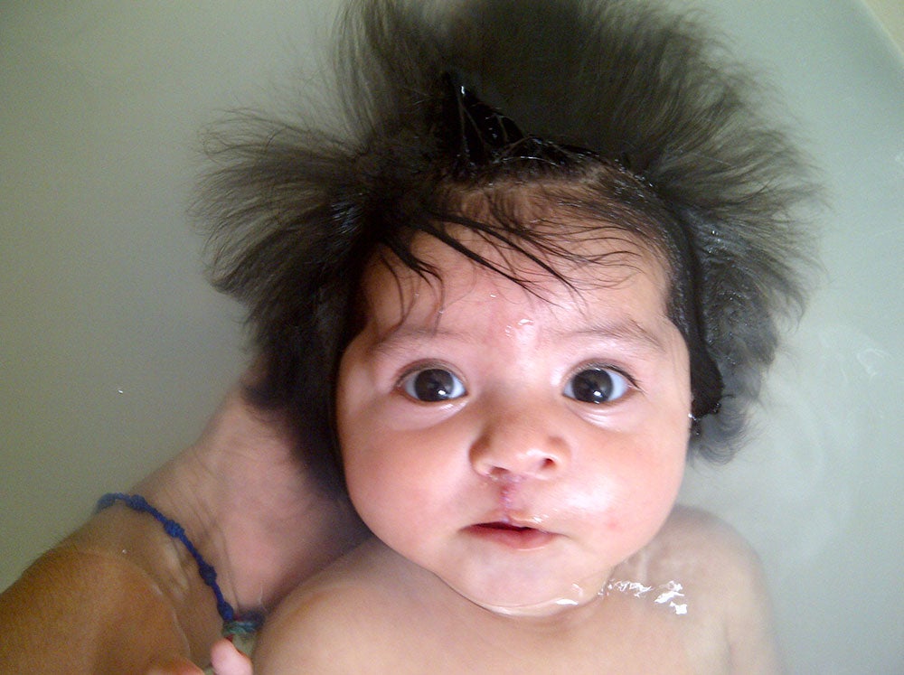 Barbara in the bathtub after her Smile Train cleft surgery