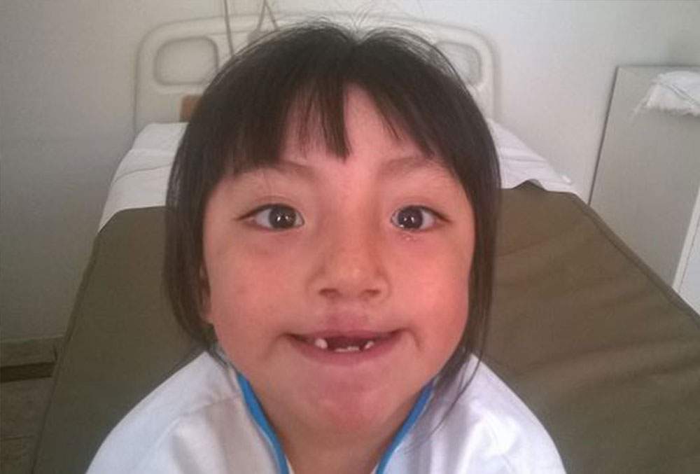 Chiara após sua segunda cirurgia de lábio leporino, aos cinco anos