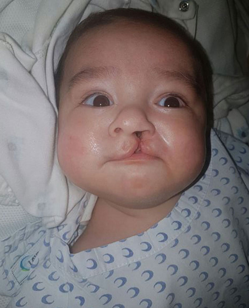 Damian quando bebê, antes da cirurgia de fissura