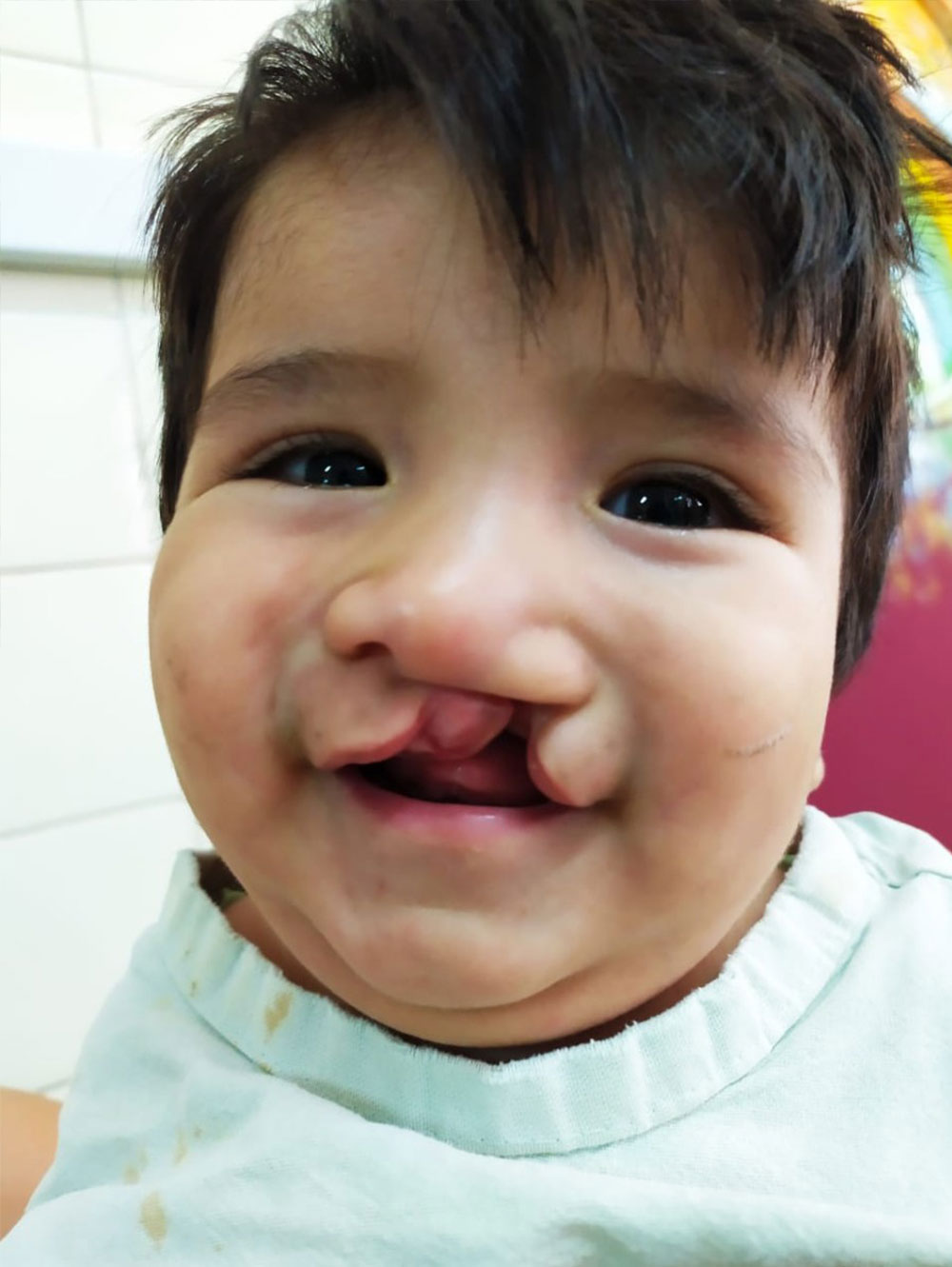 Felix antes de sua cirurgia de lábio leporino gratuita patrocinada pela Smile Train na Argentina