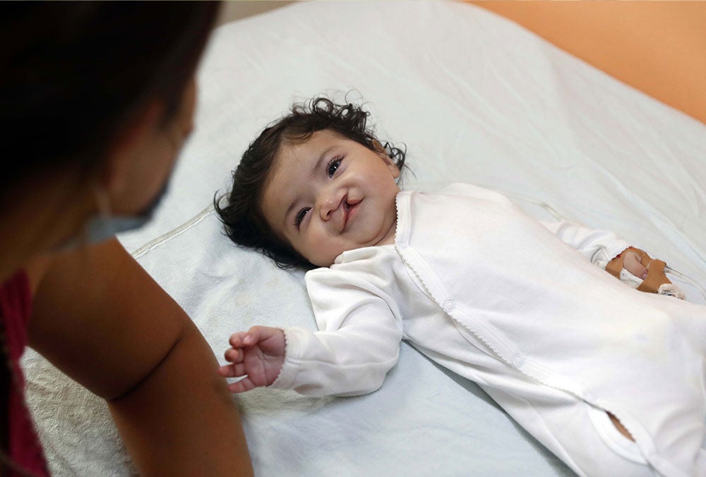 Gianna sorrindo antes da cirurgia de lábio leporino