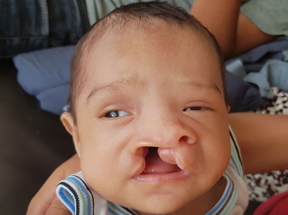 Joseyur before free Smile Train-sponsored cleft surgery