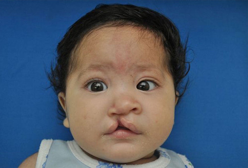 Juan before Cleft Surgery