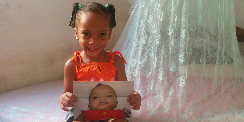Maria holding a photo of herself before cleft surgery