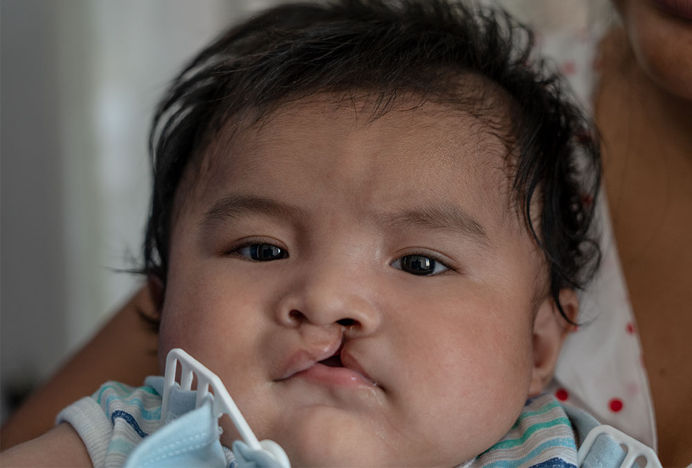 Miguel before cleft surgery