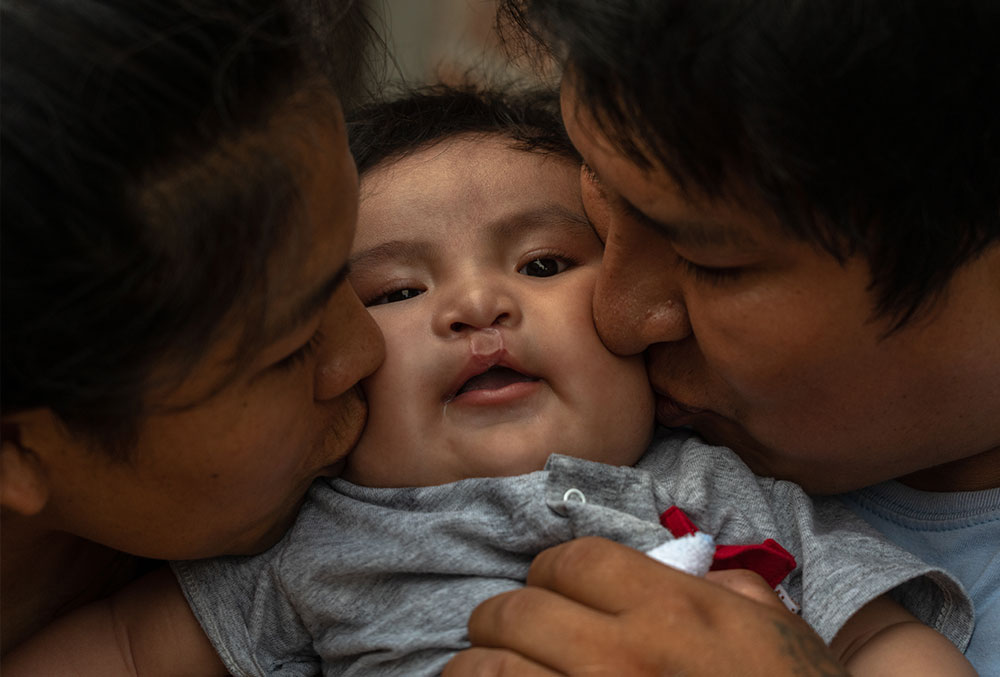 Zulema and Jose kiss Miguel after his cleft surgery