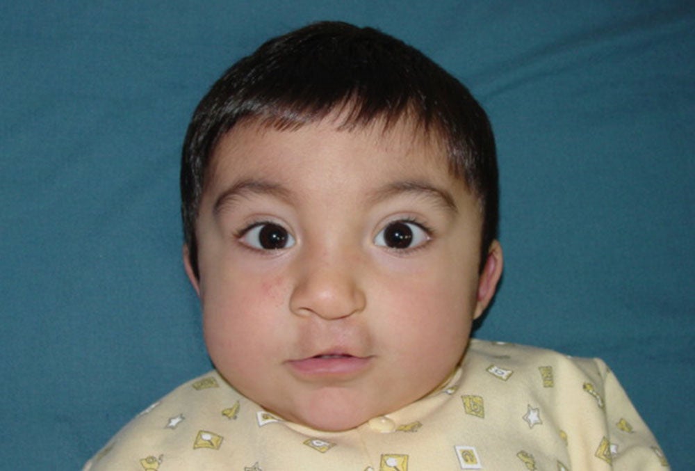 Vicente after his first cleft surgery