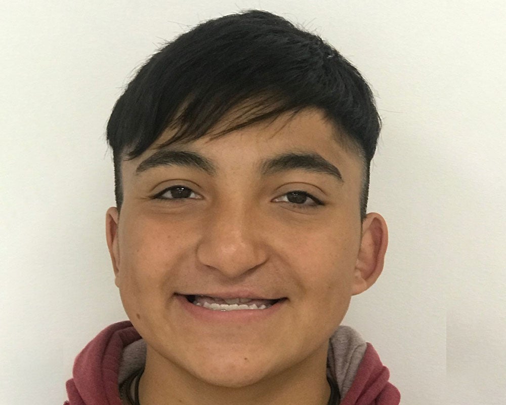 Vicente as teenager after cleft surgery