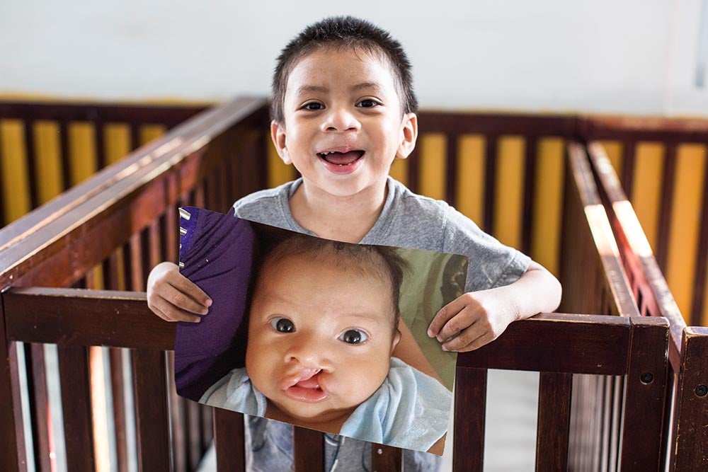 Auner sorrindo e segurando uma foto de si mesmo antes da cirurgia de fissura