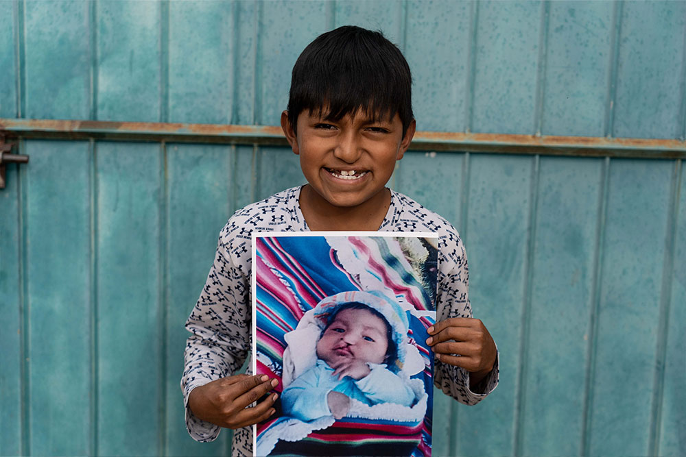 Luis smiling and holding a picture of himself before cleft surgery