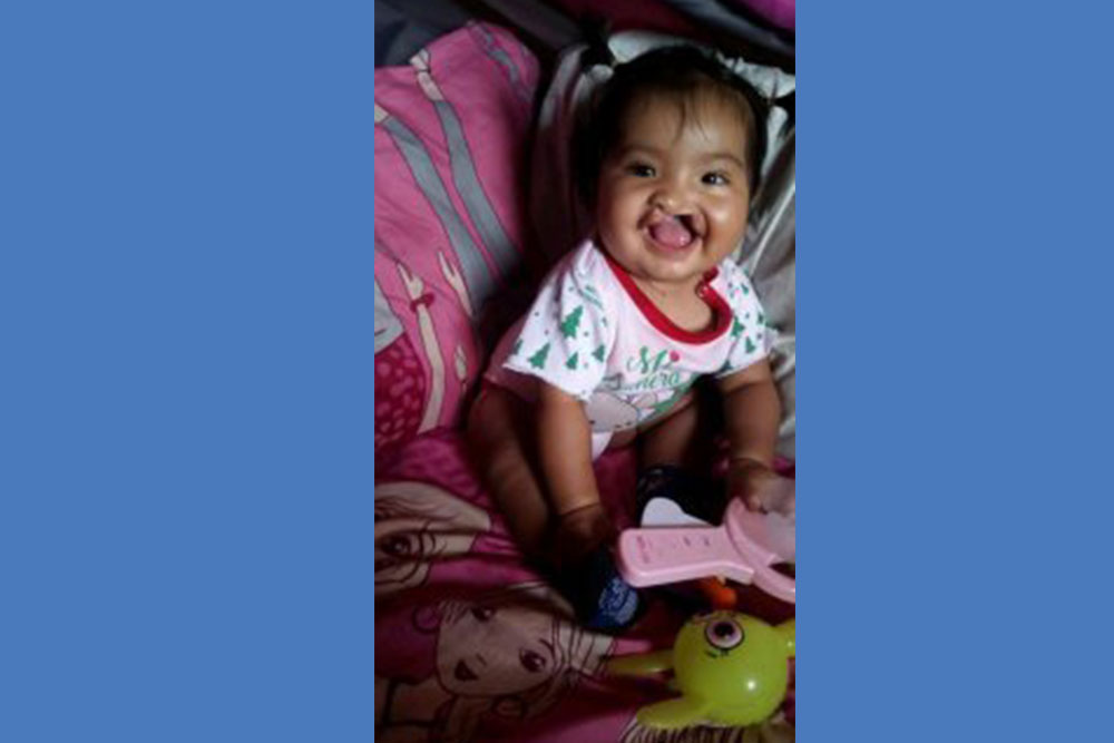Shaymi smiling before cleft surgery