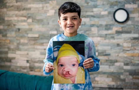 Joaquin holding a picture of himself before cleft surgery