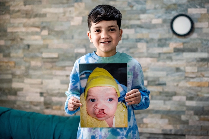 Joaquin holding a picture of himself before cleft surgery