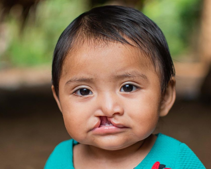 What does it mean to be a child with an untreated cleft?