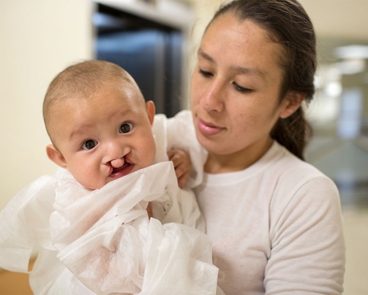 bebê com lábio leporino bilateral
