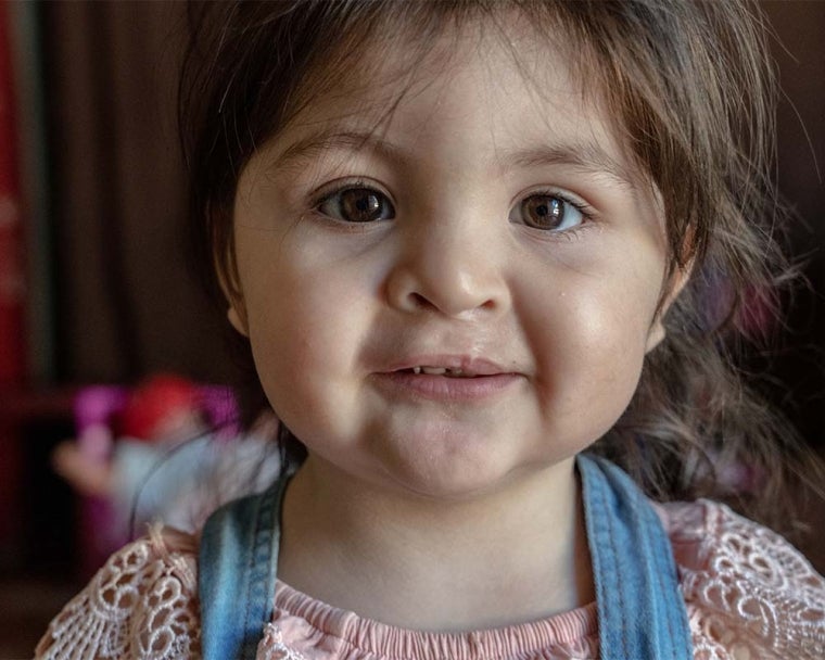 Close up of Luaxana after cleft surgery