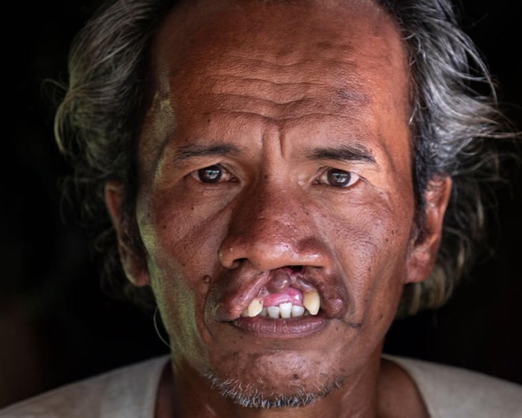 Alim antes da cirurgia de fissura labial