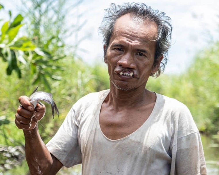 Alim pescando antes da cirurgia de fissura labial